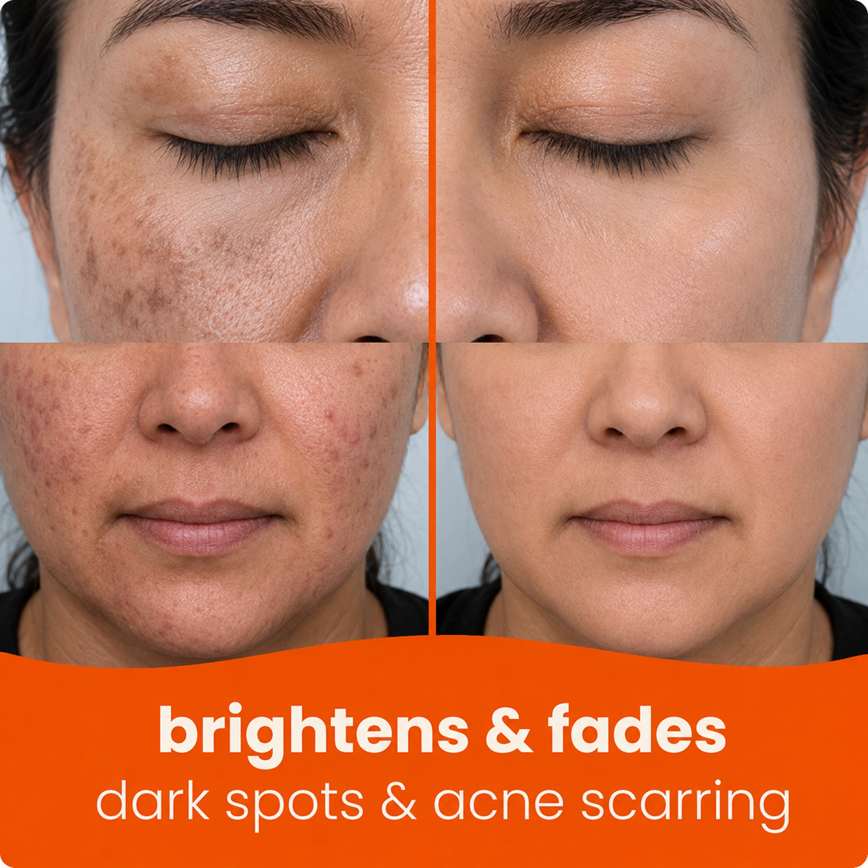 🔥Last Day 68% OFF-Virginca Turmeric Kojic Glow Pads